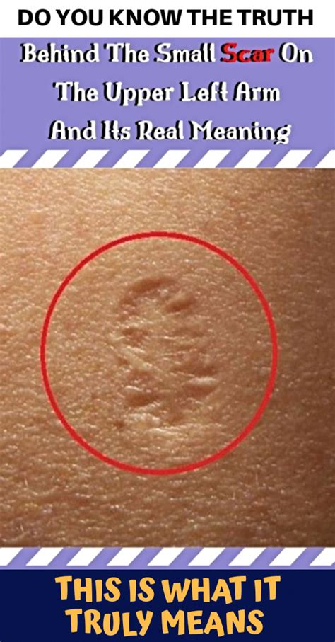 This Is The Truth Behind The Scar Everyone Has On The Upper Left Arm | Skin grafting, Scar, Scar ...