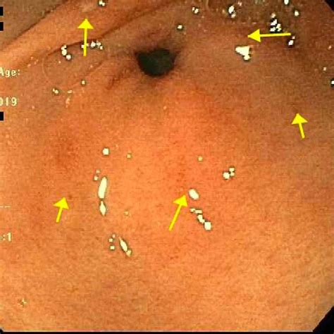 Several superficial ulcers without stigmata of bleeding in the gastric ...