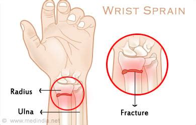 Wrist Sprain - Causes, Symptoms, Diagnosis, Treatment