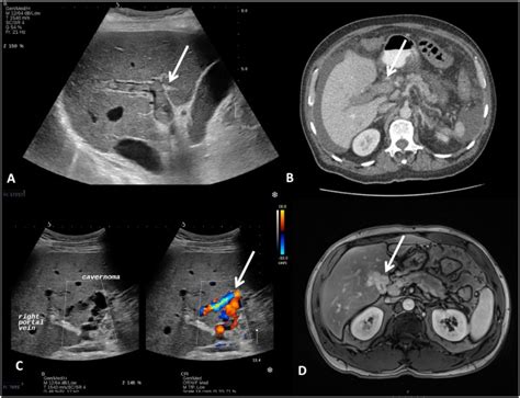 Portal vein thrombosis: The role of imaging in the clinical setting - Digestive and Liver Disease