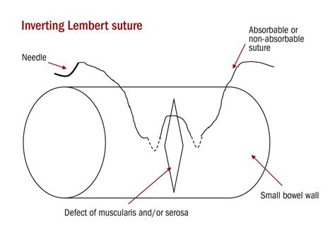 Approaching intraoperative bowel injury | MDedge ObGyn