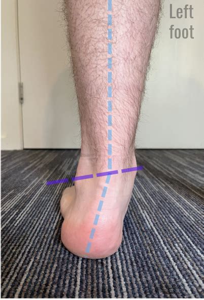 Supination Of Ankle