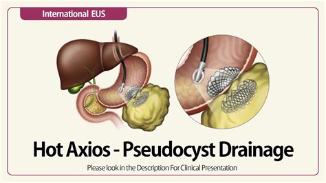 Linear EUS: Hot Axios Pseudocyst Drainage - YouTube