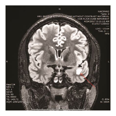 Brain MRI demonstrating left temporal lobe lesion. (a, c) Axial and ...