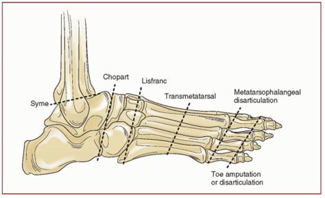 Midfoot Amputations | Musculoskeletal Key