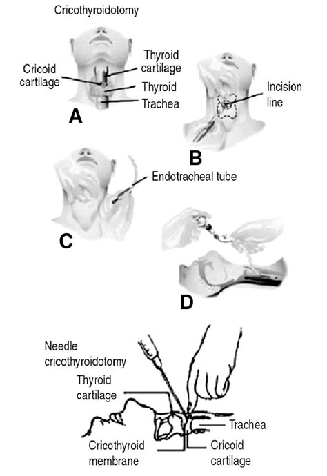 Cricothyroidotomy Anatomy