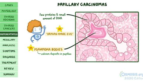 Papillary Thyroid Cancer Orphan Annie Eyes