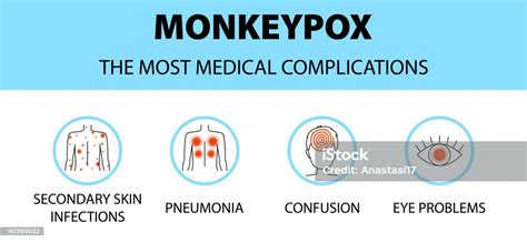 Monkeypox Virus Icons Infographic The Most Medical Complications New Outbreak Cases In Europe ...