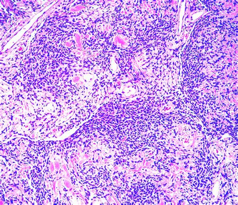 Pathology Outlines - Solitary fibrous tumor