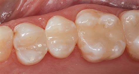 Direct Composite Restorations in the Posterior Region | March 2019 | Inside Dentistry