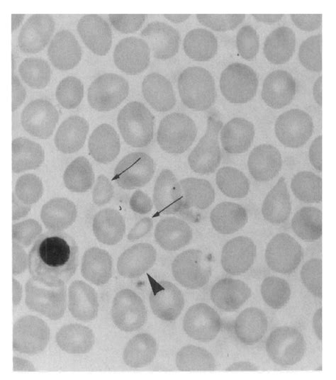 Peripheral blood smear from a patient with agnogenic myeloid ...