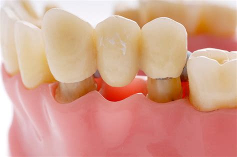 4 Types Of Dental Bridge | 3 Common Dental Bridge problems