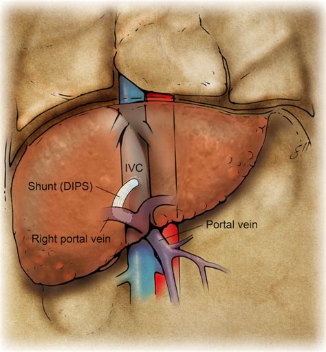 Percutaneous Direct Intrahepatic Portosystemic Shunt as a Bridge to Liver Transplantation in ...