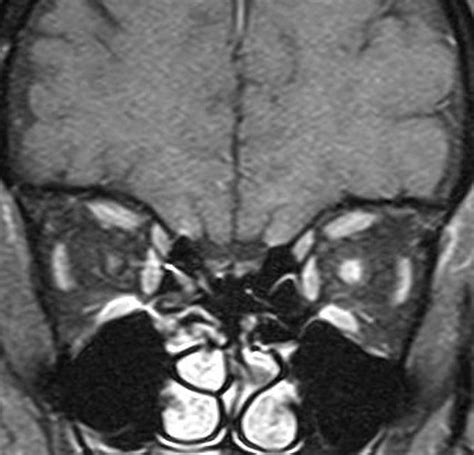 Normal Optic Nerve Mri