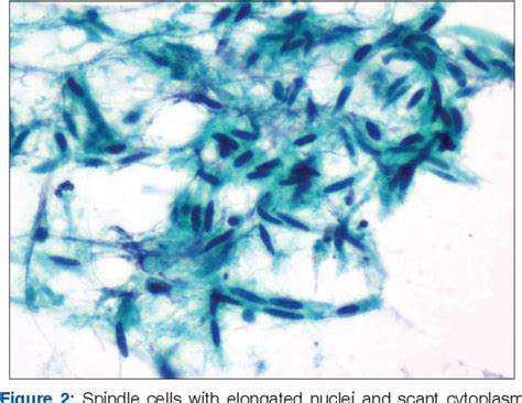 Figure 2 from Metastatic spindle cell melanoma on cytology – a diagnostic challenge | Semantic ...