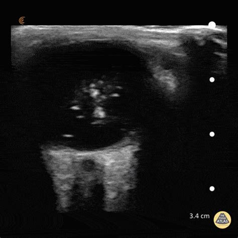 Ocular Ultrasound Vitreous Hemorrhage