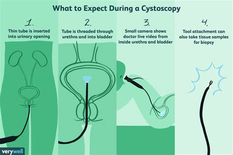 Cystoscopy: Uses, Side Effects, Procedure, Results