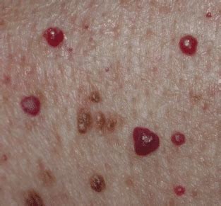 Blood Spots on Skin, Red, Tiny, Raised, Itchy, Bumps, Pictures, Causes, Get Rid - Lightskincure