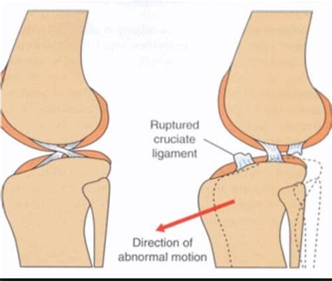 Why Choose MMP Over TPLO for Cranial Cruciate Ligament Tear Of The Dog Knee in Pensacola, FL ...