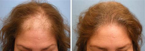 Five Step Female Hair Loss Treatment