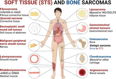 Sarcoma- Definition, Symptoms, Diagnosis and Treatment