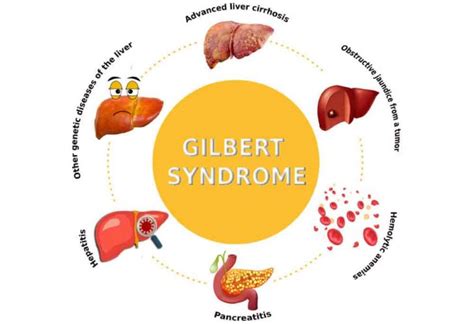 Gilbert's Syndrome GS; Causes, Symptoms, Diagnosis & Treatment