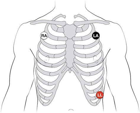 [DIAGRAM] Telemetry 3 Lead Diagram - MYDIAGRAM.ONLINE