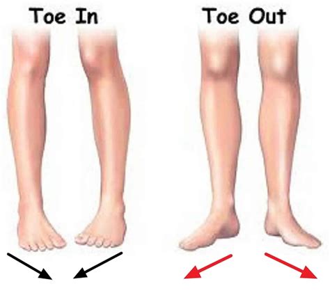 Out toeing causes, symptoms, diagnosis, treatment & prognosis