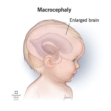 Macrocephaly: What It Is, Causes, Symptoms & Treatment