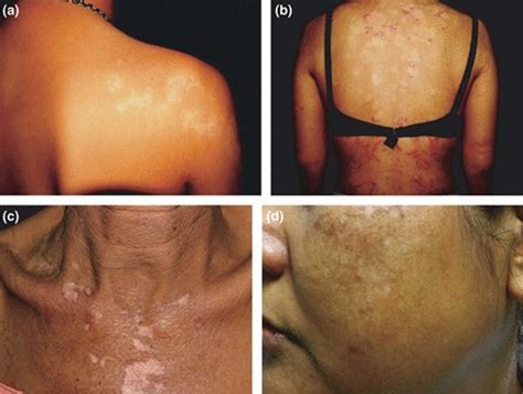 Postinflammatory hypopigmentation, causes, symptoms, diagnosis, treatment & prognosis