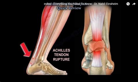 Achilles Tendon Rupture Quick Review — OrthopaedicPrinciples.com