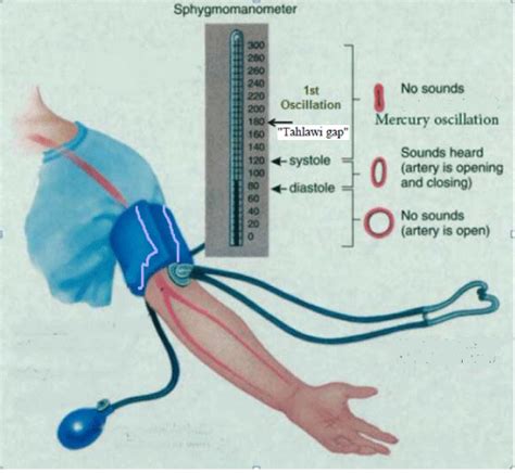 tisztít gát Az értelmező silent gap in blood pressure measurement Liszt Megbízható Gengszter