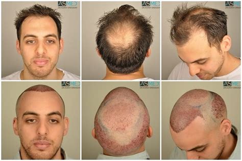 Results - Norwood 5 | Asmed Hair Transplant