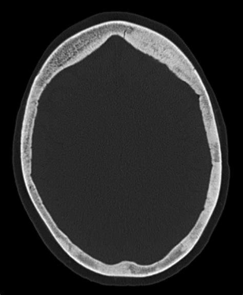 Imaging of focal calvarial lesions - Clinical Radiology