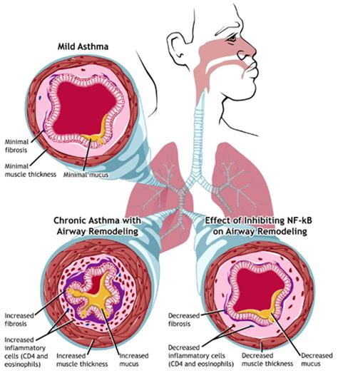 Why do Children Get Asthma | HubPages