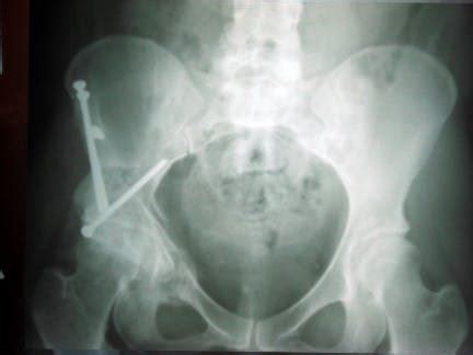 Hip osteotomy Surgery Cost and Procedure Information