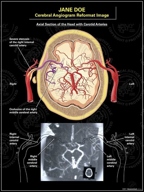 Angiography Brain