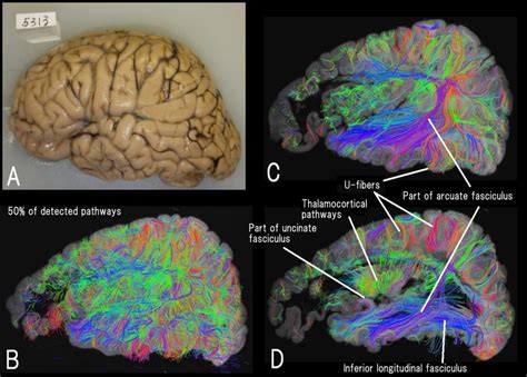 High-angular resolution diffusion MRI (HARDI) tractography of a left... | Download Scientific ...