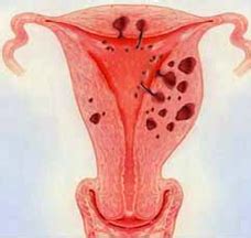 Adenomyosis - Birmingham Fibroid Clinic