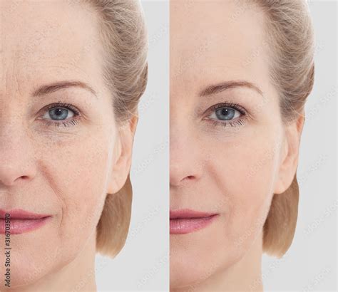 Middle age close up woman happy face before after cosmetic procedures ...