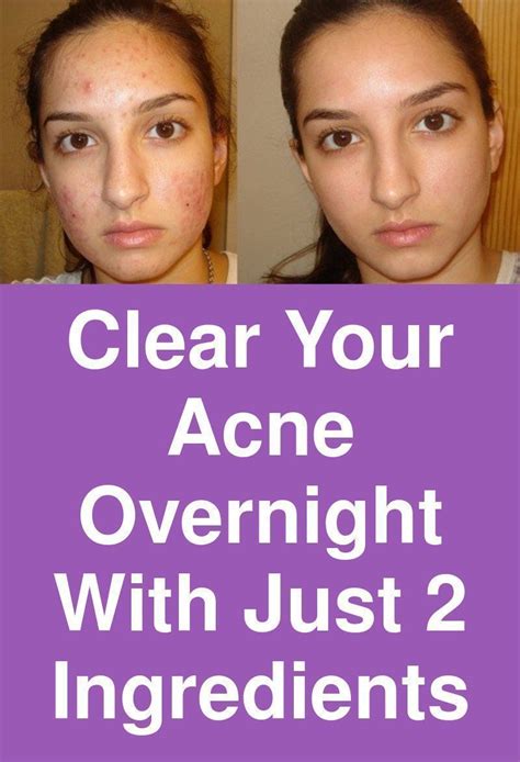 10 Ways to Get Rid of a Pimple Overnight | Acne overnight, Bad acne, Pimples remedies