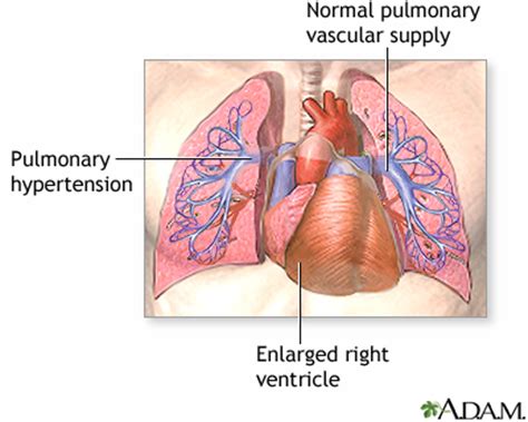 Heart-lung transplant - series—Indications: MedlinePlus Medical Encyclopedia