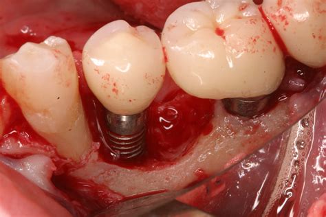 Dental implant contamination: 3 reasons behind a late-stage failure | Perio-Implant Advisory