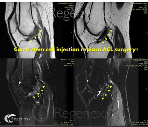 Can a Precise Knee ACL Stem Cell Injection Regrow a Torn ACL? - Regenexx®