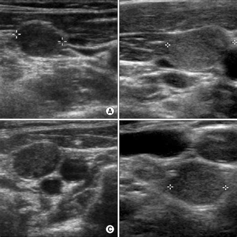 Ultrasound images of central lymph node metastasis. (A) LNM with a loss... | Download Scientific ...