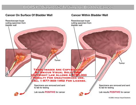 AMICUS Illustration of amicus,medical,biopsy,diagnostic,testing,cancer,bladder,wall,surface ...