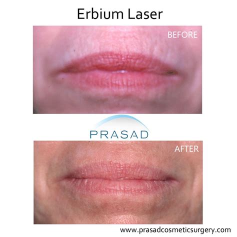 What’s the Best Treatment for Wrinkles Above Lips? | Dr. Prasad Blog