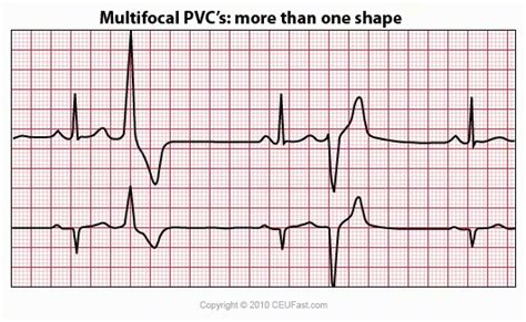 17 Best images about EKG on Pinterest | Qrs complex, Physiology and St ...