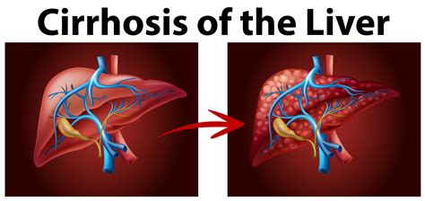 Diagram showing cirrhosis of the liver 292464 Vector Art at Vecteezy