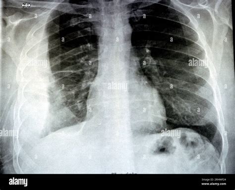 Plain X ray for a patient with aspiration pneumonia right lung, empyema, pleural effusion after ...